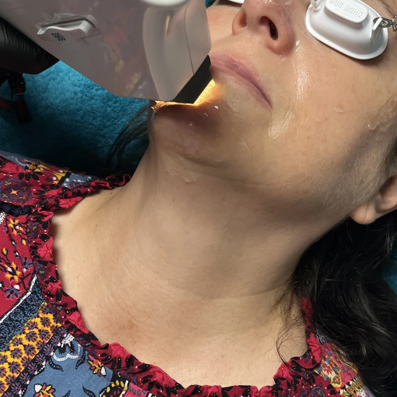Facial hair removal Maryport