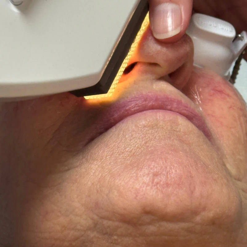 Laser Hair Removal Maryport