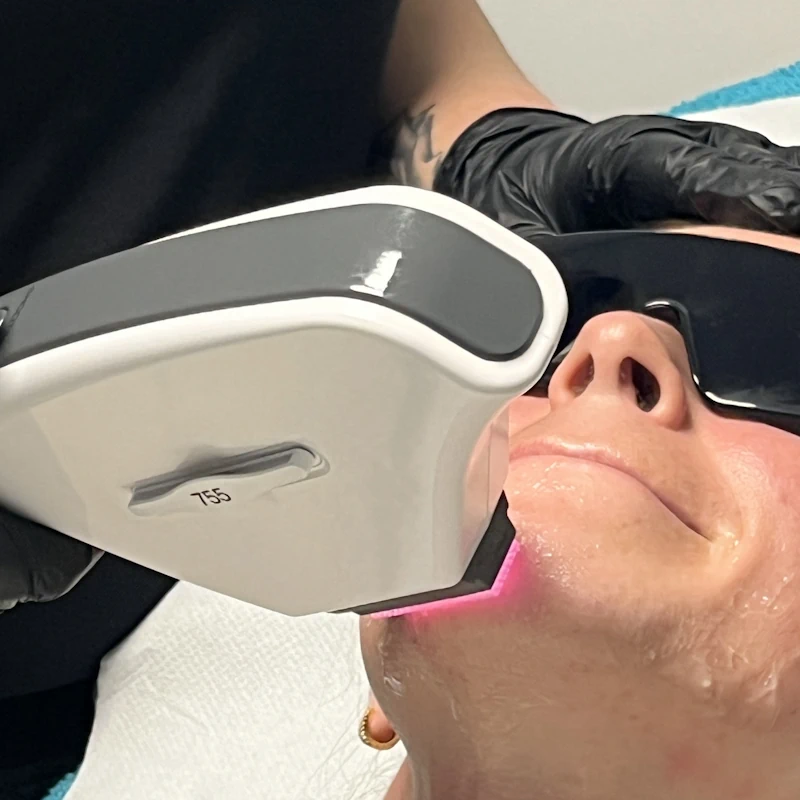 Facial hair removal Maryport