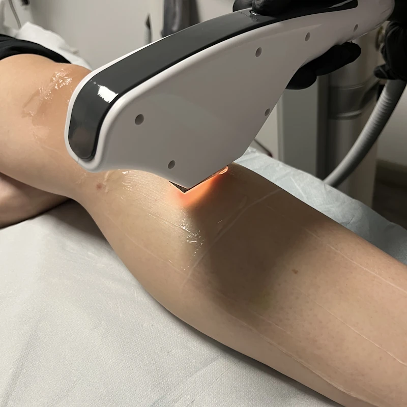 IPL Hair Removal in Maryport, Cumbria